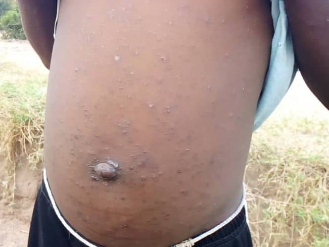 Kasaï – Santé :  “kuankara”, nouvelle épidémie signalée dans les zones de santé rurale de Ndjoko Punda et Luebo