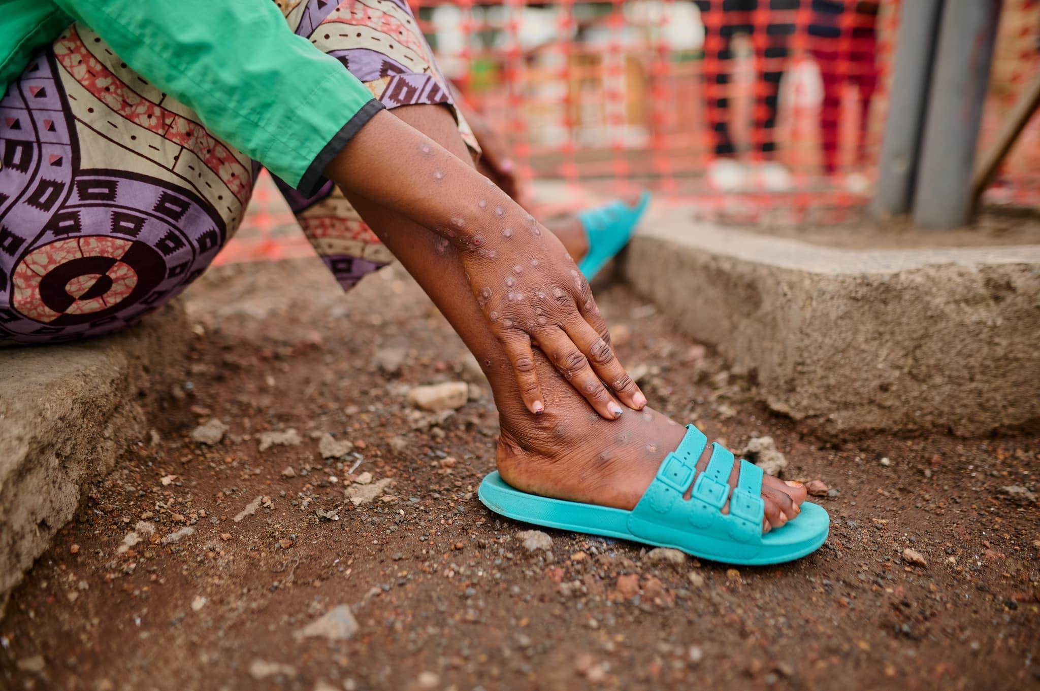 Santé : L’EFCHESP annonce la tenue d’un colloque international sur le M-Pox